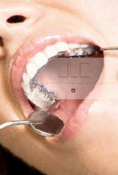 Ortodoncia invisible lingual hechos a medida calidad autoligado JLC servicios dentales exclusivos